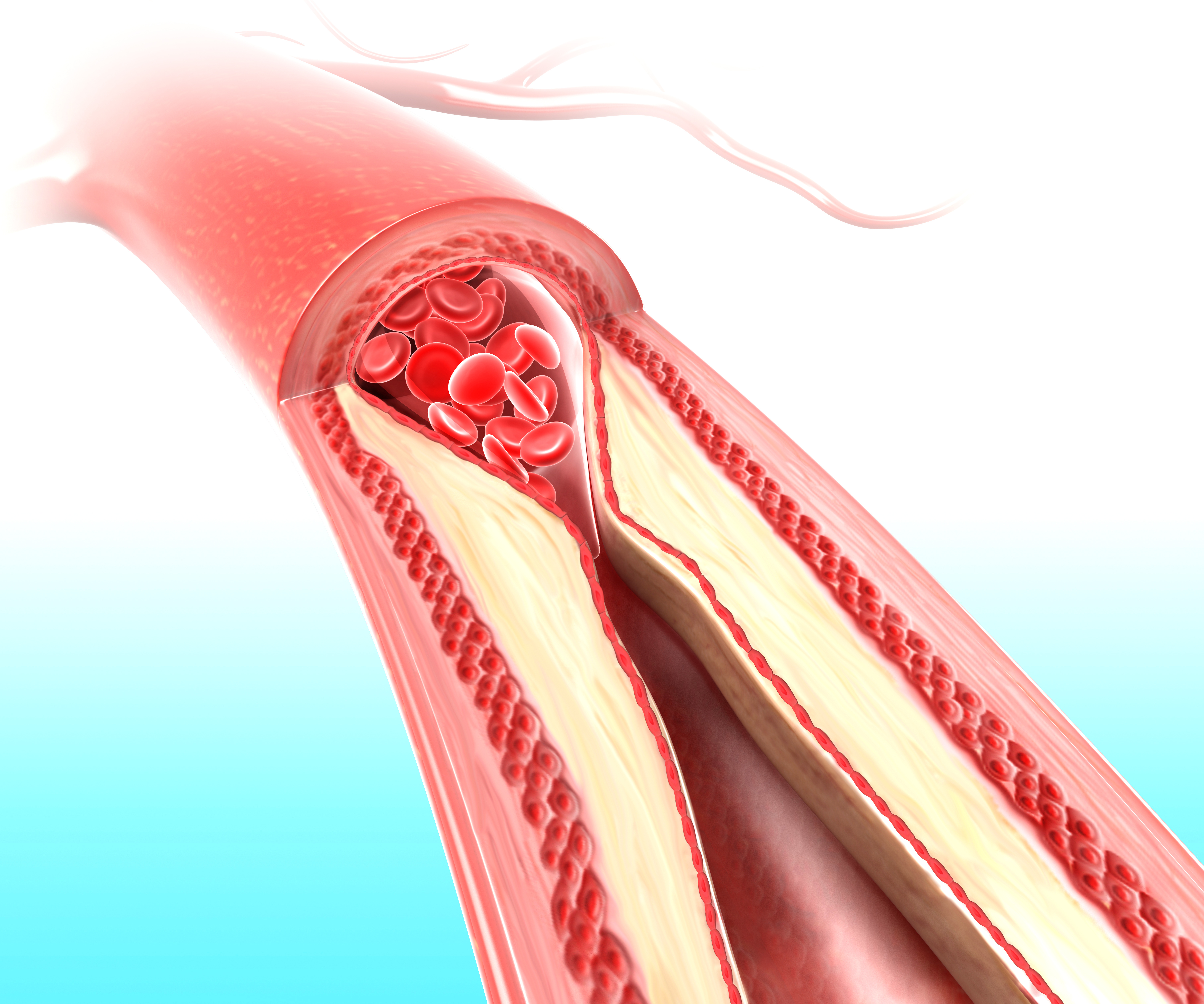 Расширение артериальных сосудов. Атеросклероз (закупорка кровеносных сосудов). Облитерирующий атеросклероз.